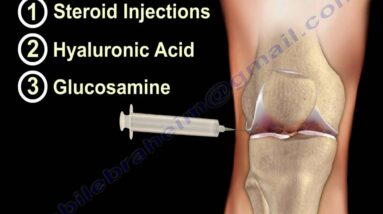 Knee pain ,arthritis and Injured Cartilage  - Everything You Need To Know - Dr. Nabil Ebraheim, M.D.